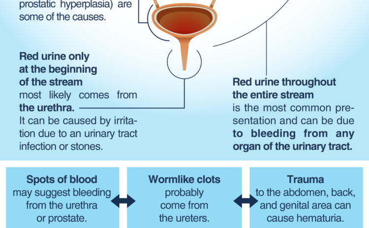  HEMATURIA