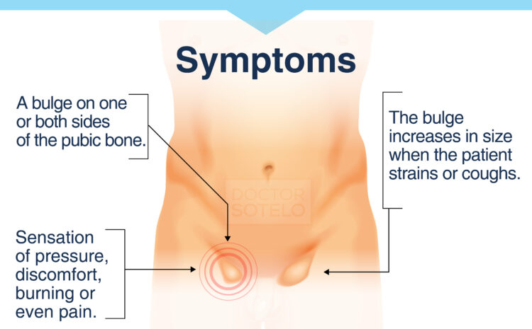  Inguinal hernia