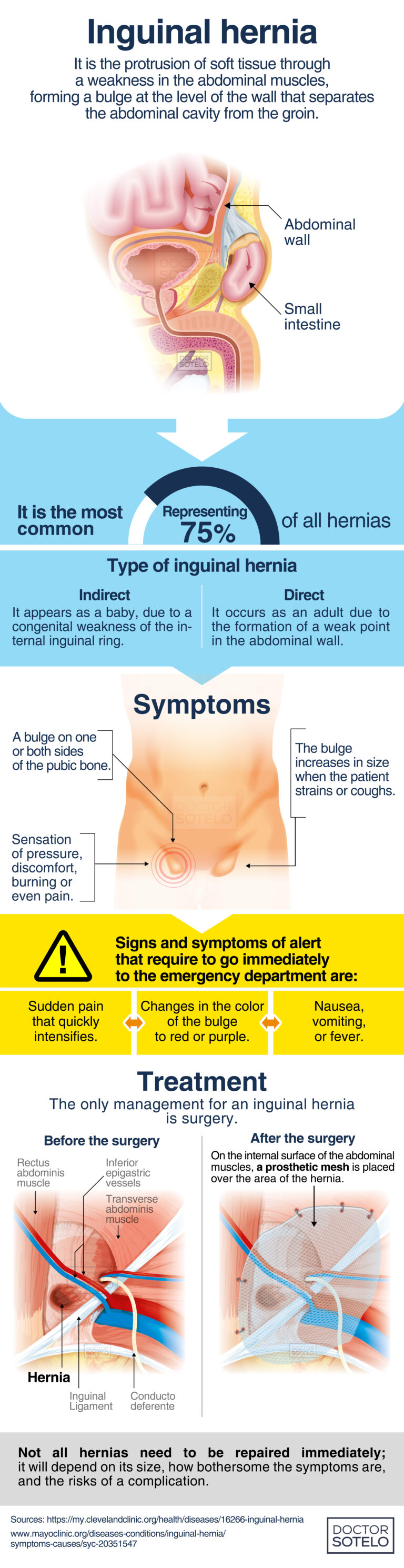 Inguinal hernia