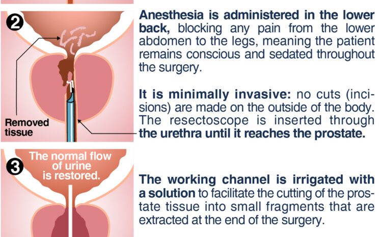  TRANSURETHRAL RESECTION OF THE PROSTATE